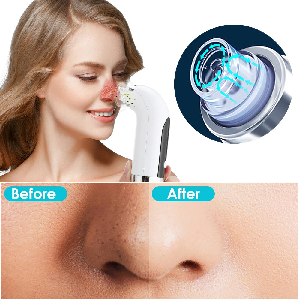 Blackhead Remover Pore Cleaner Vacuum